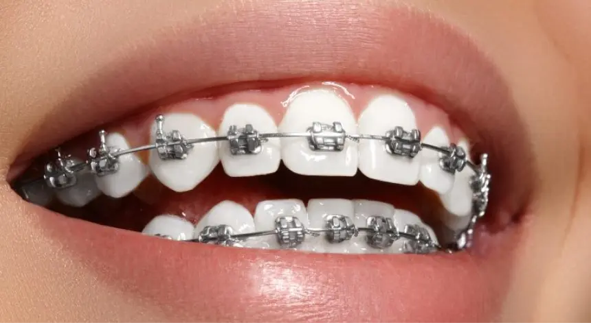 Braces